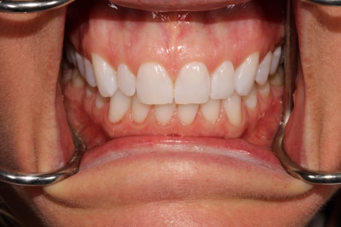No-Prep Veneers