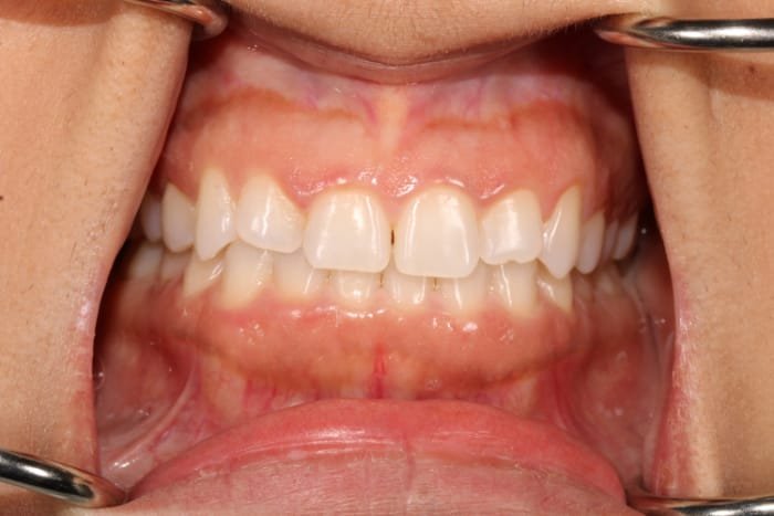Veneers Before & After Gallery - Patient 39774549 - Image 1