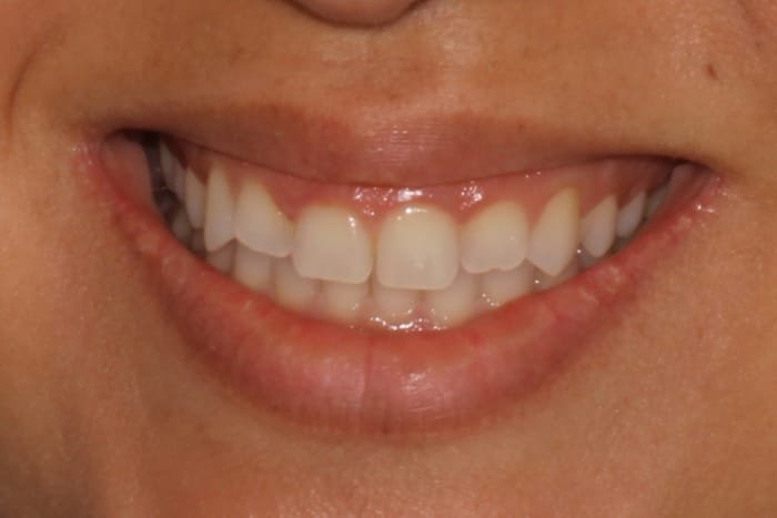 Veneers Before & After Gallery - Patient 39774549 - Image 3
