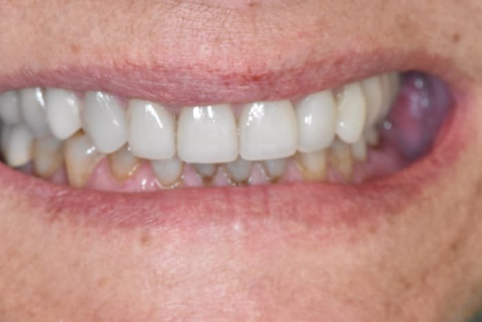 Veneers Before & After Gallery - Patient 39578479 - Image 2