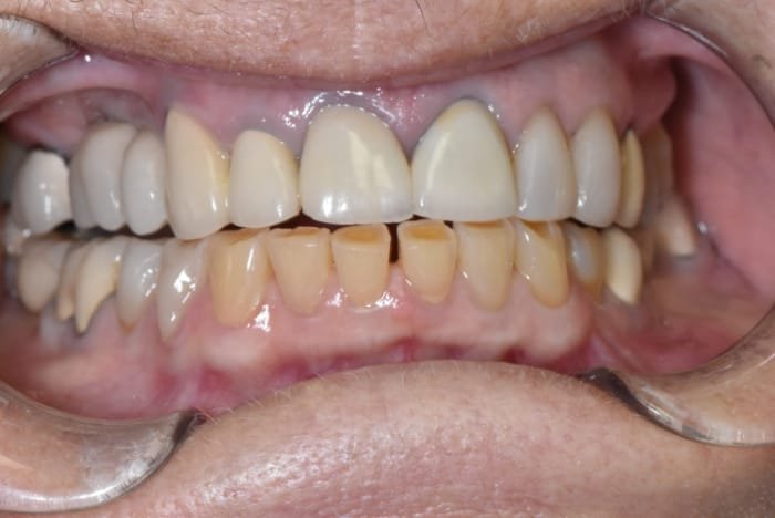 Smile Makeover Before & After Gallery - Patient 39578480 - Image 1