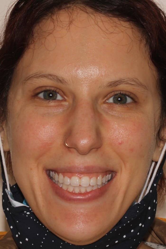 Laser Gum Contouring Before & After Gallery - Patient 39578489 - Image 1