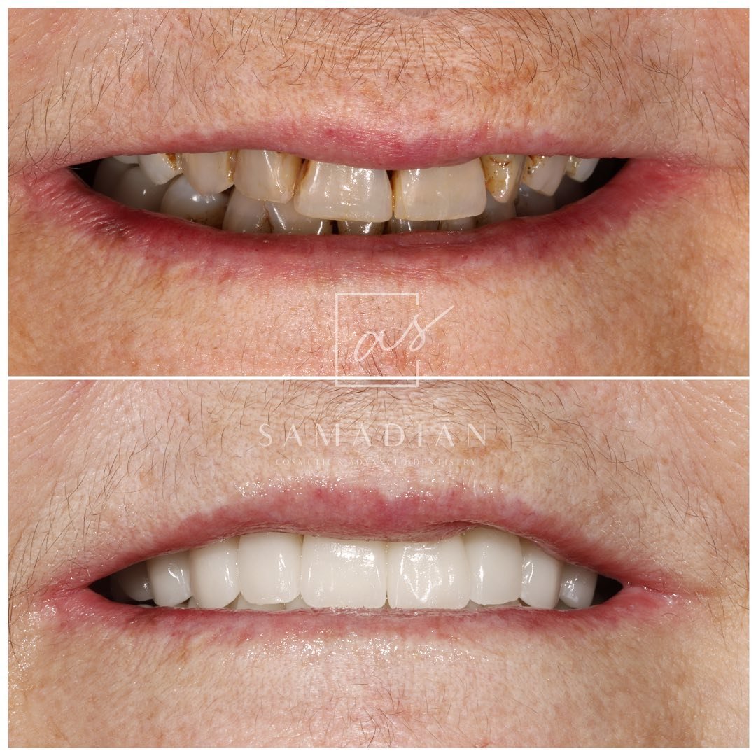 Smile Makeover Before & After Gallery - Patient 54674902 - Image 1