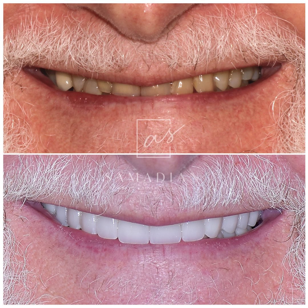 Smile Makeover Before & After Gallery - Patient 39578157 - Image 1