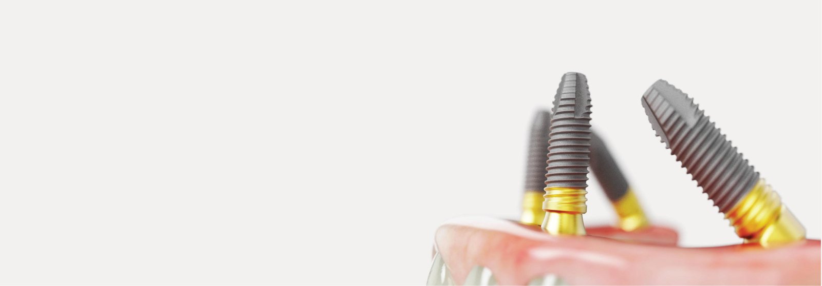 dental implants